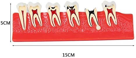 KH66ZKY Стоматолошки заби Модел на заби - Кариес модел - Развој на кариес и секундарна алатки за предавање на студија за типодонт на кариес