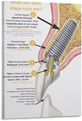 Постери Стоматолошка имплантација за стоматолошка нега Постер за стоматолошка клиника Постер Медицински постер за планови за