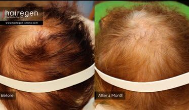 Хаирген Губење На Косата Третман За Повторно Растење Личен Уред За Кратка Коса од Хаиреген