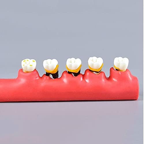 Стоматолошки периодитонтитис Асортиман Образовна демонстрација на заби модел гингивитис, орален модел на заби, хроничен периодонтитис,