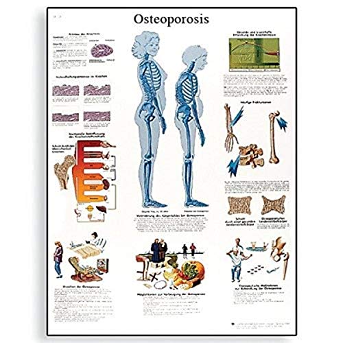 3B Научен VR1121UU сјајна хартија Остеопороза Анатомска табела, големина на постер 20 ширина x 26 Висина