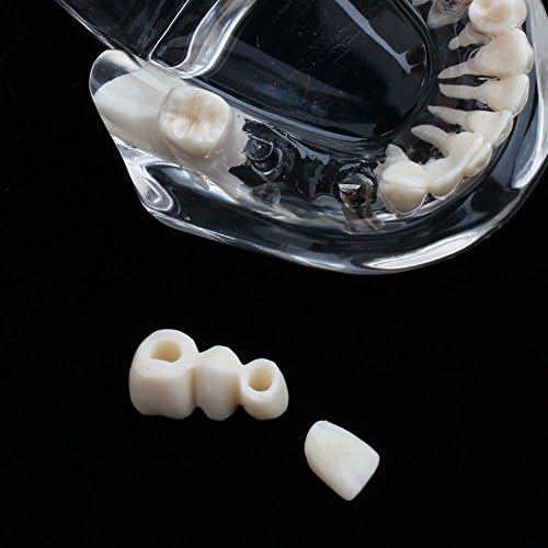 Јосу Транспарентна патологија за возрасни заболени стоматолошки стоматолог имплантација Демонстрација на пародонтот заболувања Асортимани