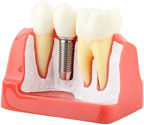 Стоматолошки модел имплантанти на заби, модел на имплантација Стоматолошки импланти, стоматолошки модел на круна мост, демонстрации