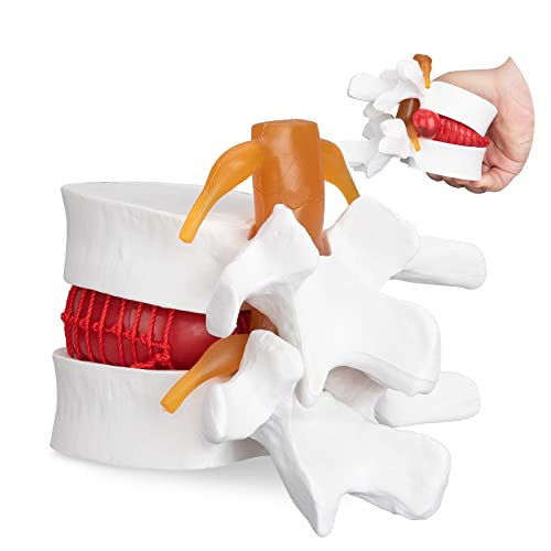 Модел на хернијација на дискови LVCHEN - Човечки лумбален диск Хернијација на 'рбетниот модел 1.5x Интервертебрален диск модел Анатомски