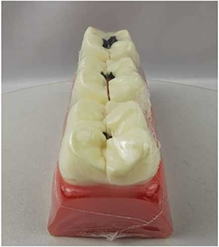 KH66ZKY Стоматолошки кариес модел на заби - модел на заби за патологија - 6 пати распаѓање на забите Компаративни алатки за учење на